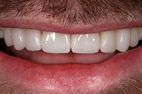 smile-2-a