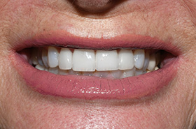 smile-after-01