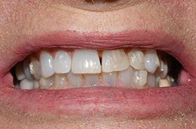 smile-before-01